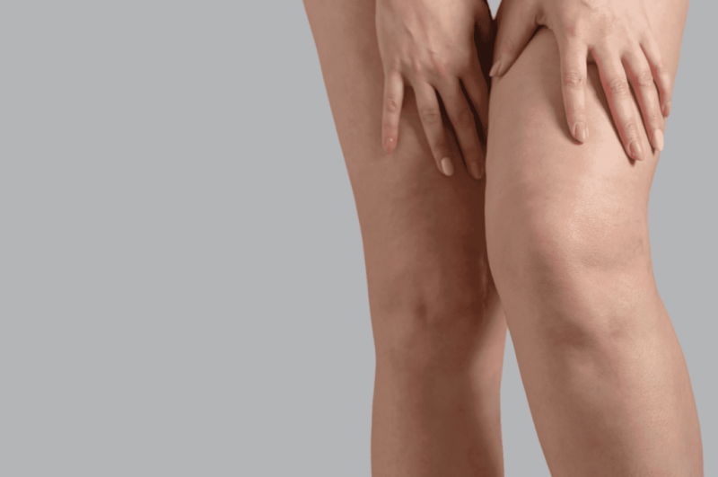 Удаление варикозных вен без боли и разрезов: как на самом деле проходит современная операция