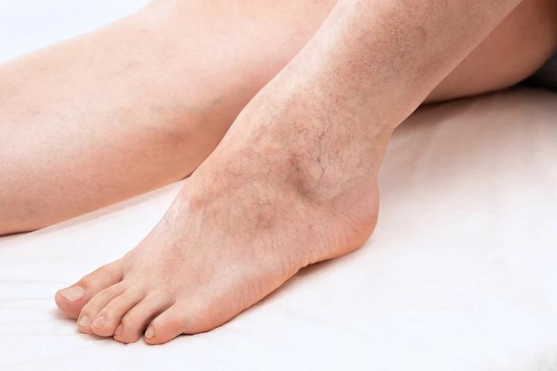 Сосудистые звездочки на ногах: косметический дефект или первый звонок варикоза?