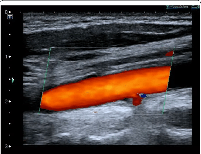 Сосуды на УЗДГ ног