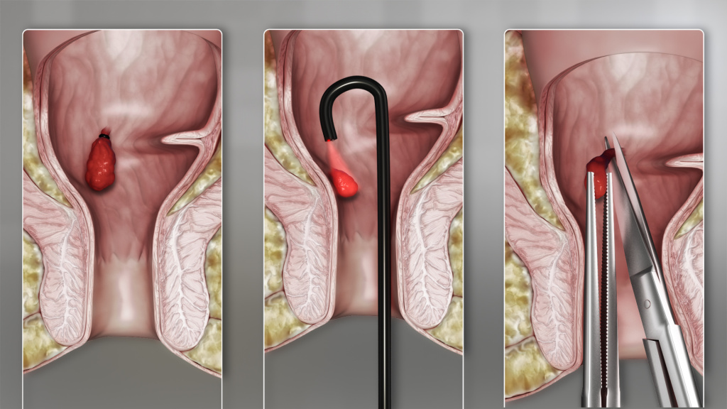 Тромбэктомия геморроидального узла