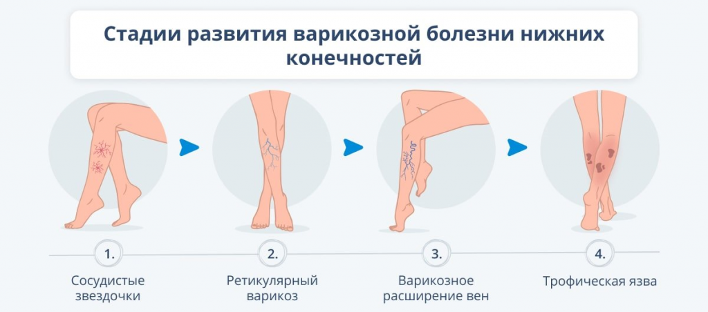 Стадии развития варикозной болезни нижних конечностей Стадии развития варикозной болезни нижних конечностей
