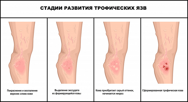 Стадии развития трофических язв