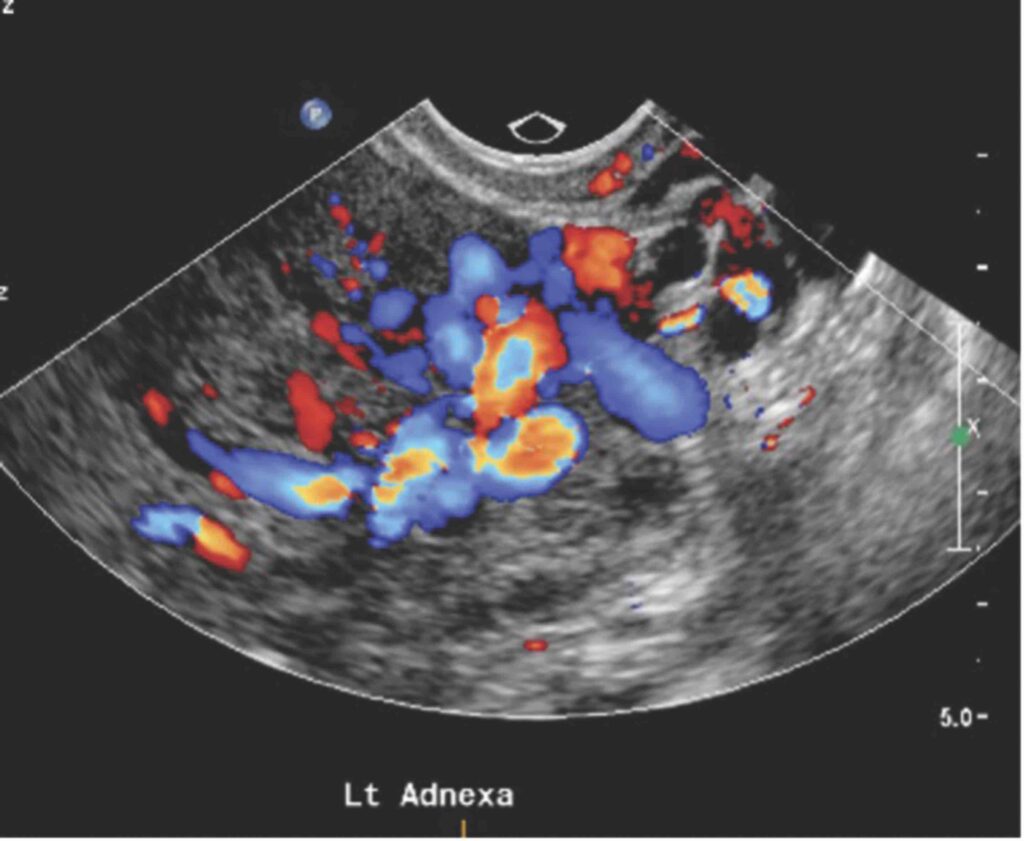 Варикоз малого таза - УЗИ