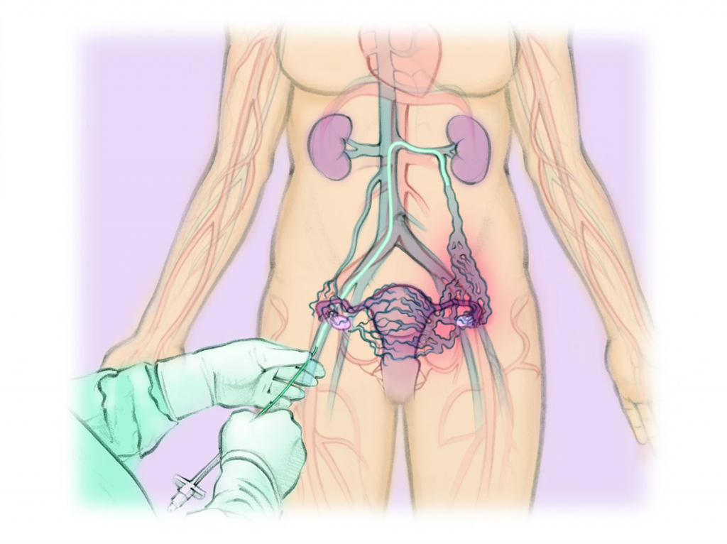 Эмболизация тазовых вен