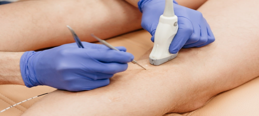 Операция по удалению вен