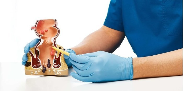 Лечение геморроя в Флебоэксперт