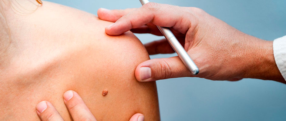 Лазерное удаление бородавок