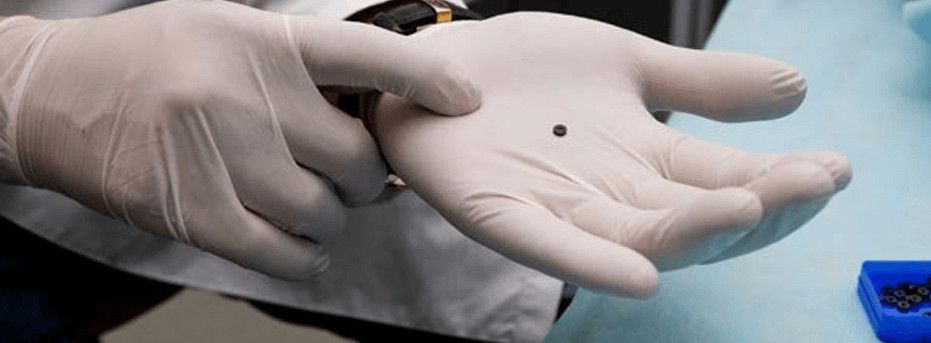 Лигирование геморроидальных узлов латексными кольцами Лигирование геморроидальных узлов латексными кольцами