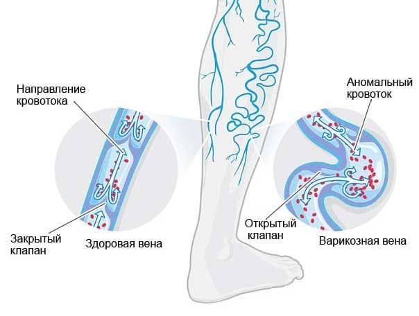 Здоровые и варикозные вены