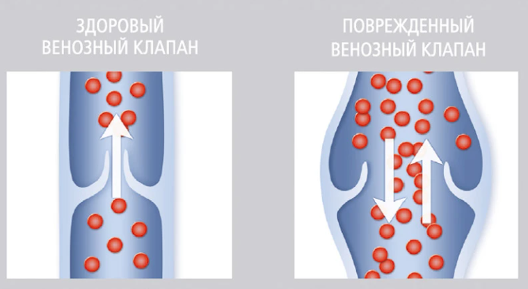 Повреждение венозного клапана