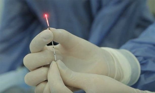 Лазерная вапоризация Лазерная вапоризация