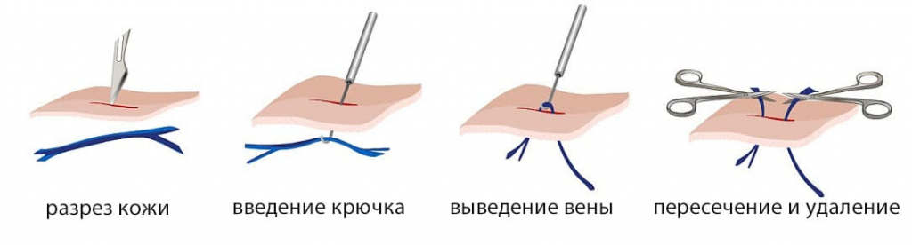 Процедура удаления вен
