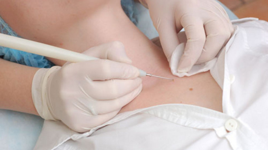 Лазерное удаление