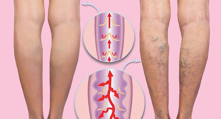 Положительные изменения после лазерной коагуляции