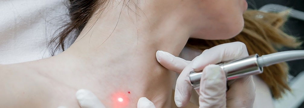 Удаление папиллом и бородавок