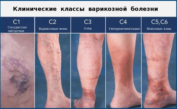 Варикоз: основная информация для женщин