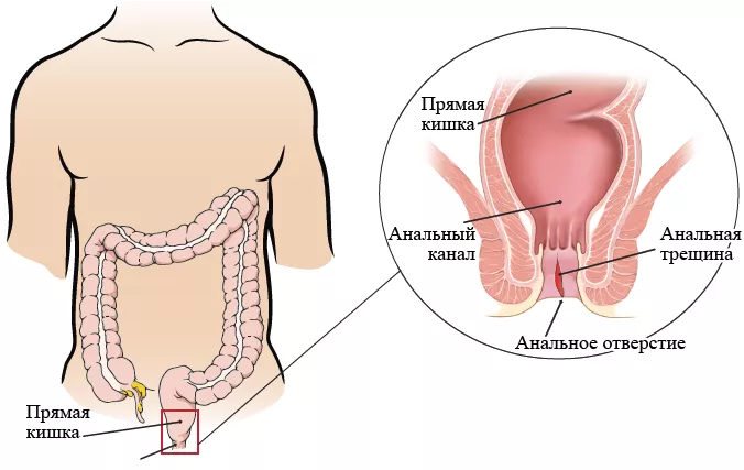 Анальные трещины