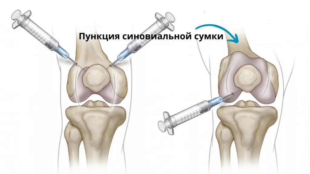 пункция синовиальной сумки сустава